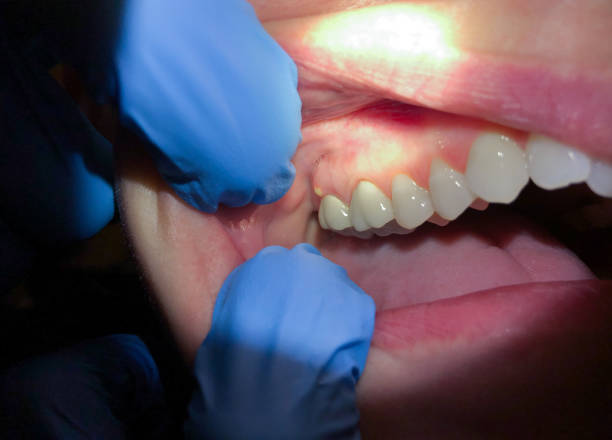 Best Tooth Infection Emergency Dentist  in Westlake, TX